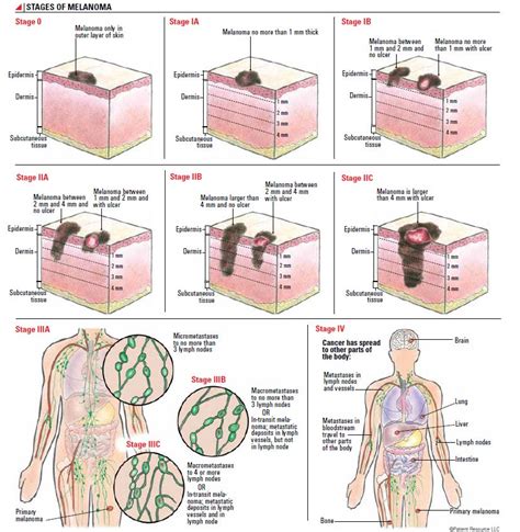 melanoma stages chart